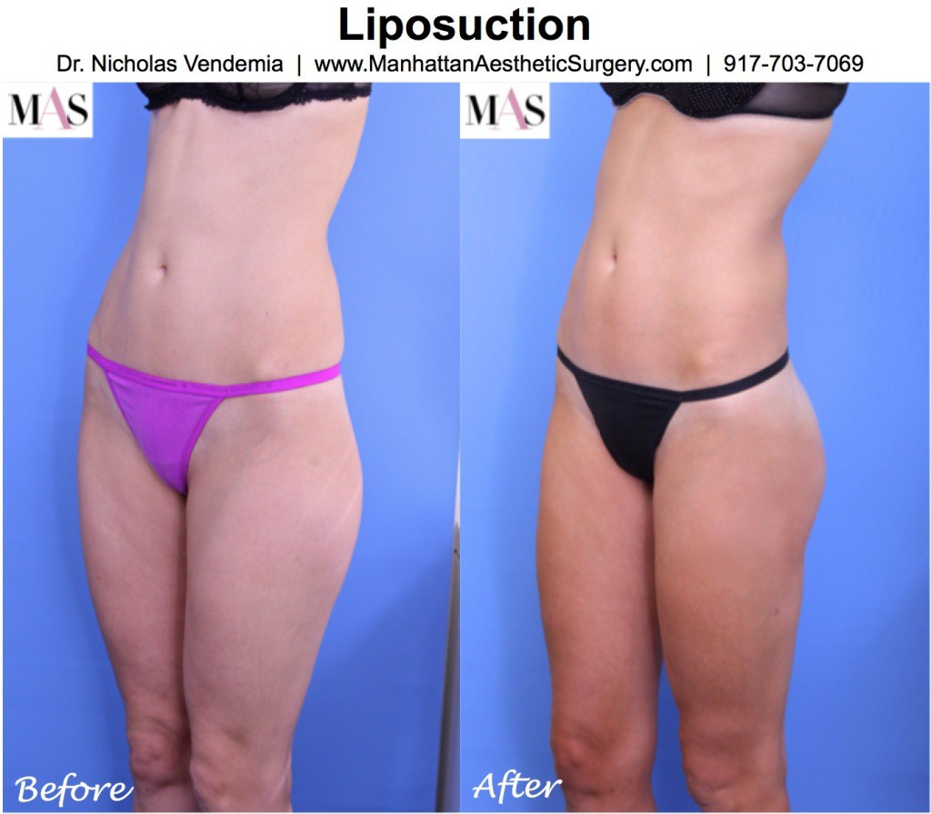 22 Wonderful What is Vaser Liposuction 2024 free download what is vaser liposuction of laser liposuction new york city dr nicholas vendemia pertaining to laser liposuction