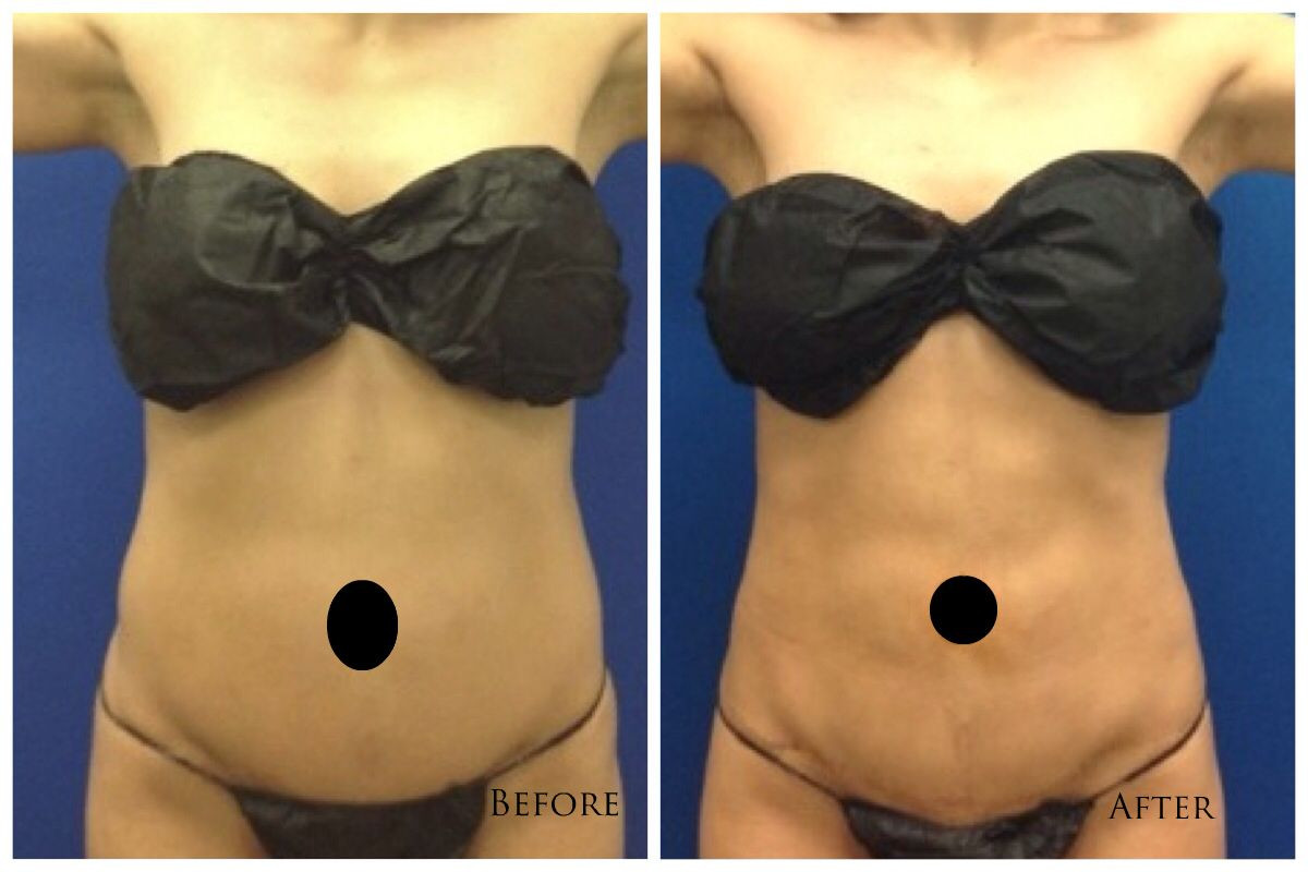 12 Cute What is Vaser Liposuction Procedure 2024 free download what is vaser liposuction procedure of body sculpting using the most advanced laser liposuction techniques with regard to body sculpting using the most advanced laser liposuction techniques 