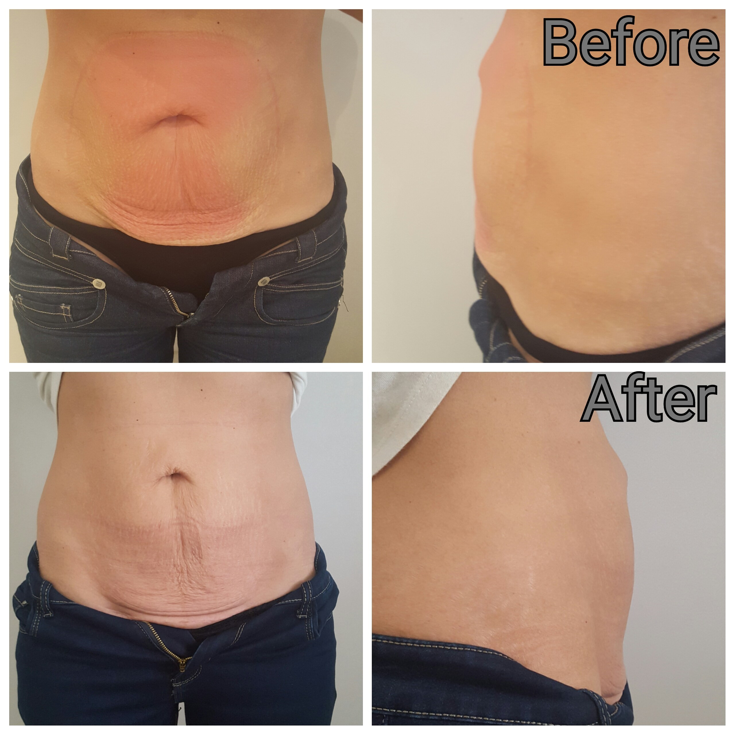 12 Cute What is Vaser Liposuction Procedure 2024 free download what is vaser liposuction procedure of fat freezing results my story pretty beautiful by sara irish pertaining to photogrid 1463231438468