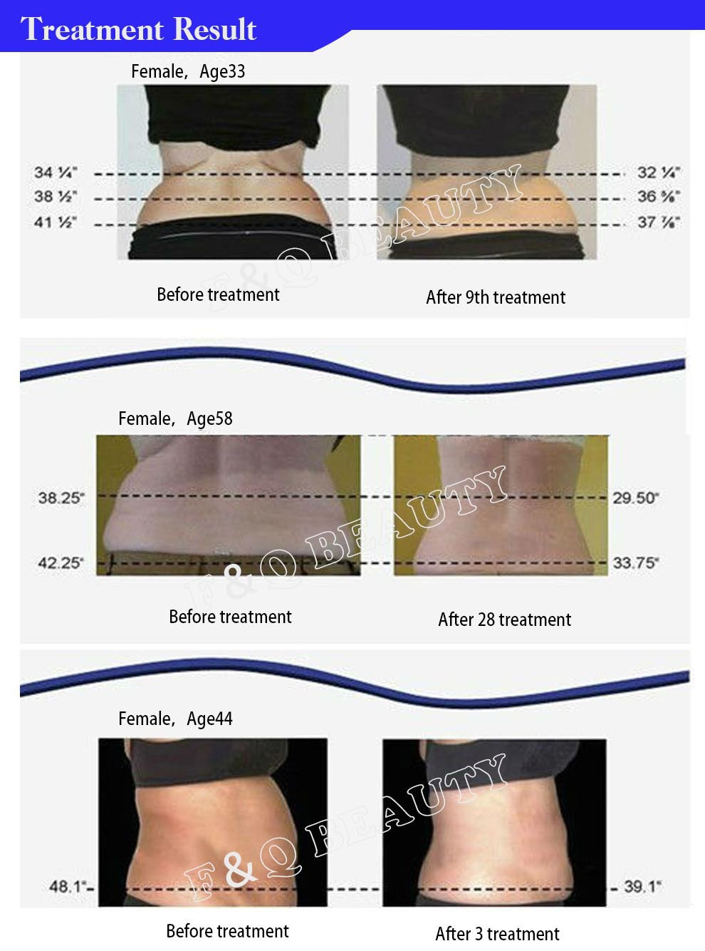12 Cute What is Vaser Liposuction Procedure 2024 free download what is vaser liposuction procedure of fqj01 portable new product skin tightening lipo laser body inside professional salon use body slender lipo laser machine for clinc