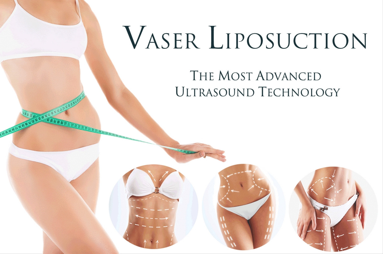 12 Cute What is Vaser Liposuction Procedure 2024 free download what is vaser liposuction procedure of liposukcja laserowa vaser dermamed wrocac282aw regarding cena od 2700 zac282